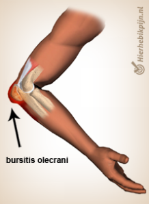 arm-bursitis-olecrani-anatomie